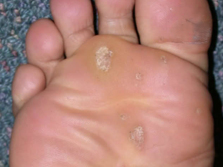 What are the symptoms of Warts and Verrucae?